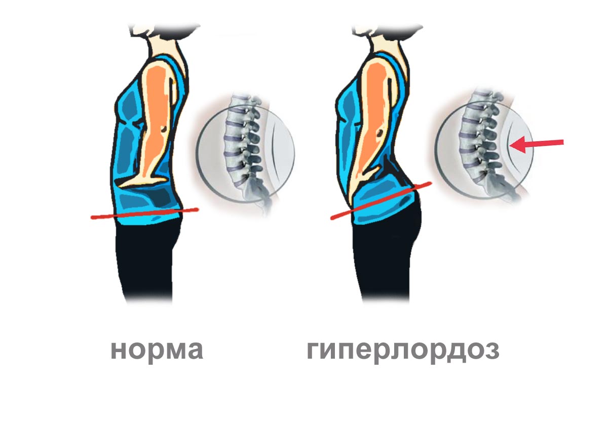 Гиперлордоз живот. Гиперлордоз причины. Гиперлордоз у женщин. Гиперлордоз и выпирающий живот.