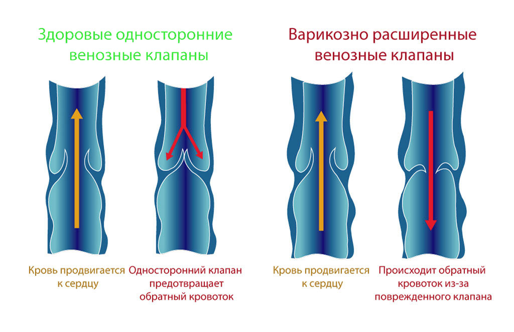 Варикоз во время беременности