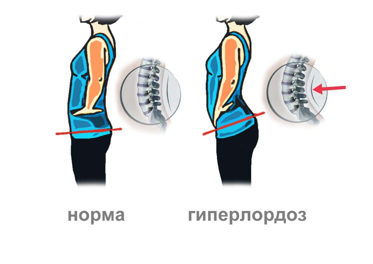 Гиперлордоз и форма живота
